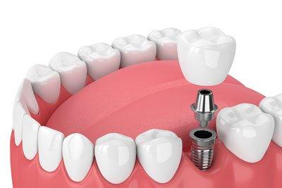 Prosthodontic | Dental Care in Icon Clinic - Abu Dhabi