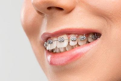 Orthodontics | Dental Care in Icon Clinic - Abu Dhabi