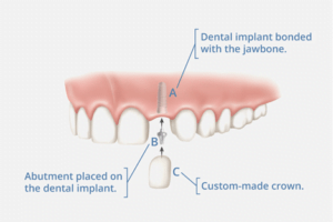 Dental Implant Tooth Replacement Abu Dhabi