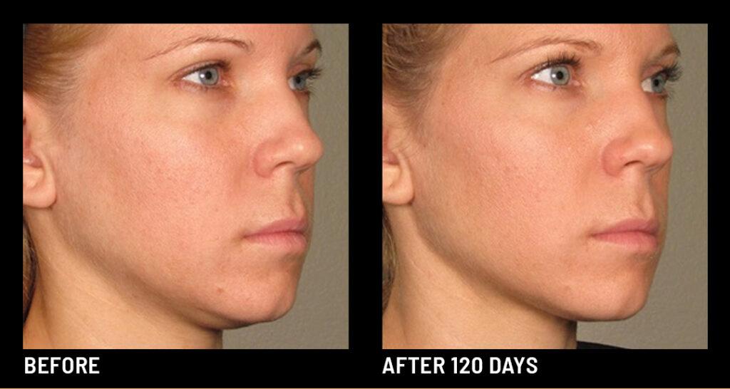 Ultherapy Before After Face Area 002